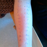 Photo de test allergie respiratoire